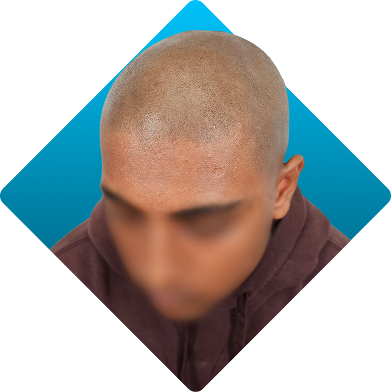 Alopecia Men 4 After