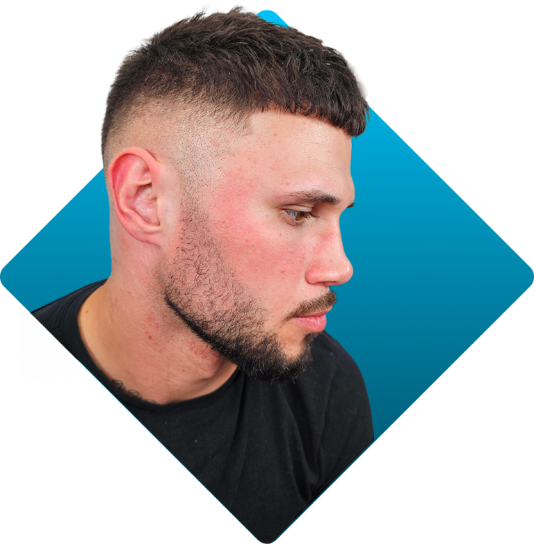 Beard Pigmentation After