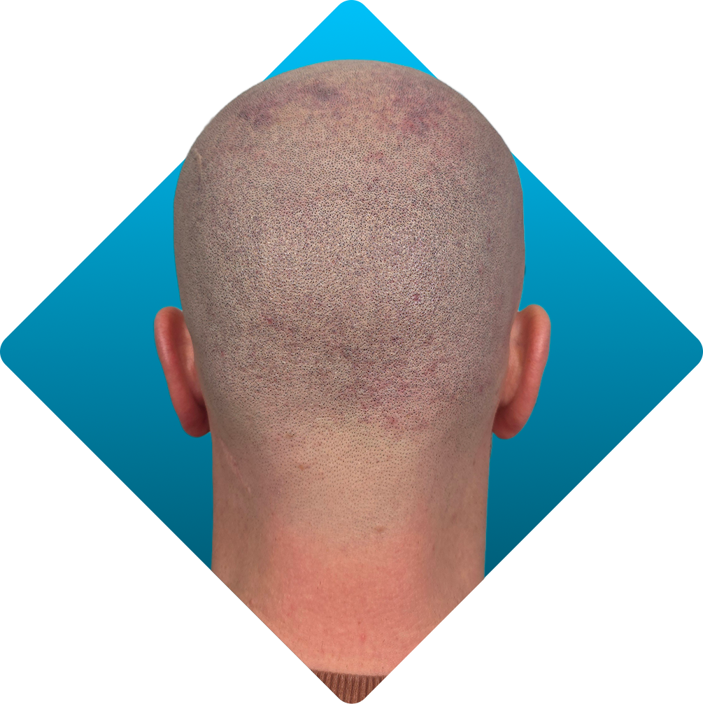 Solution -Disguising scalp scars after 2