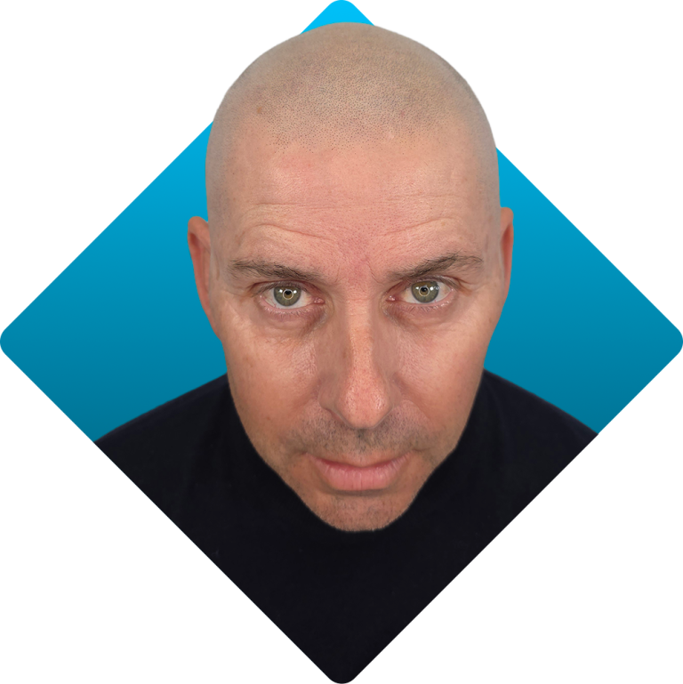 Solution - male pattern After