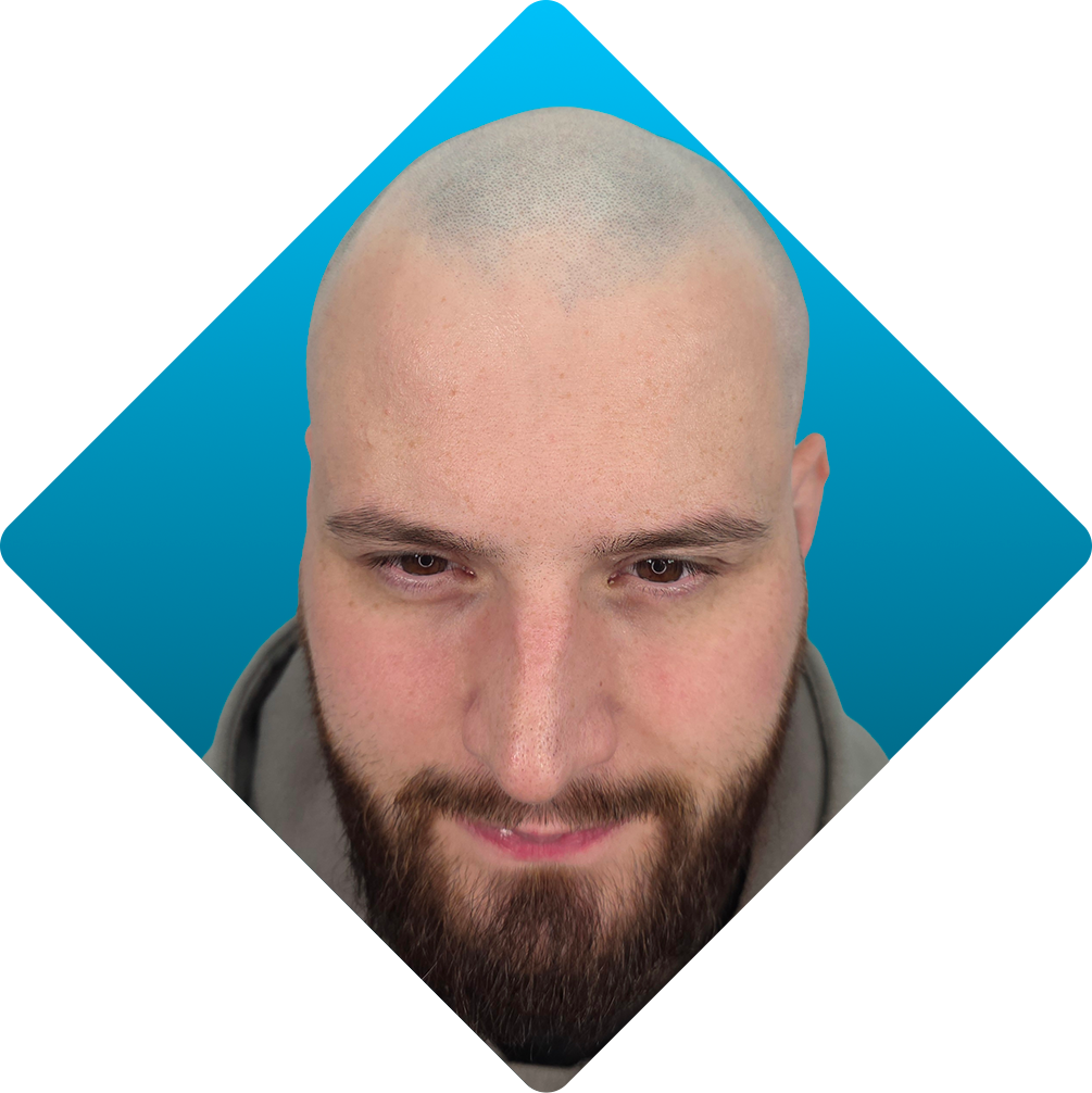 Solutions - thinning hair before