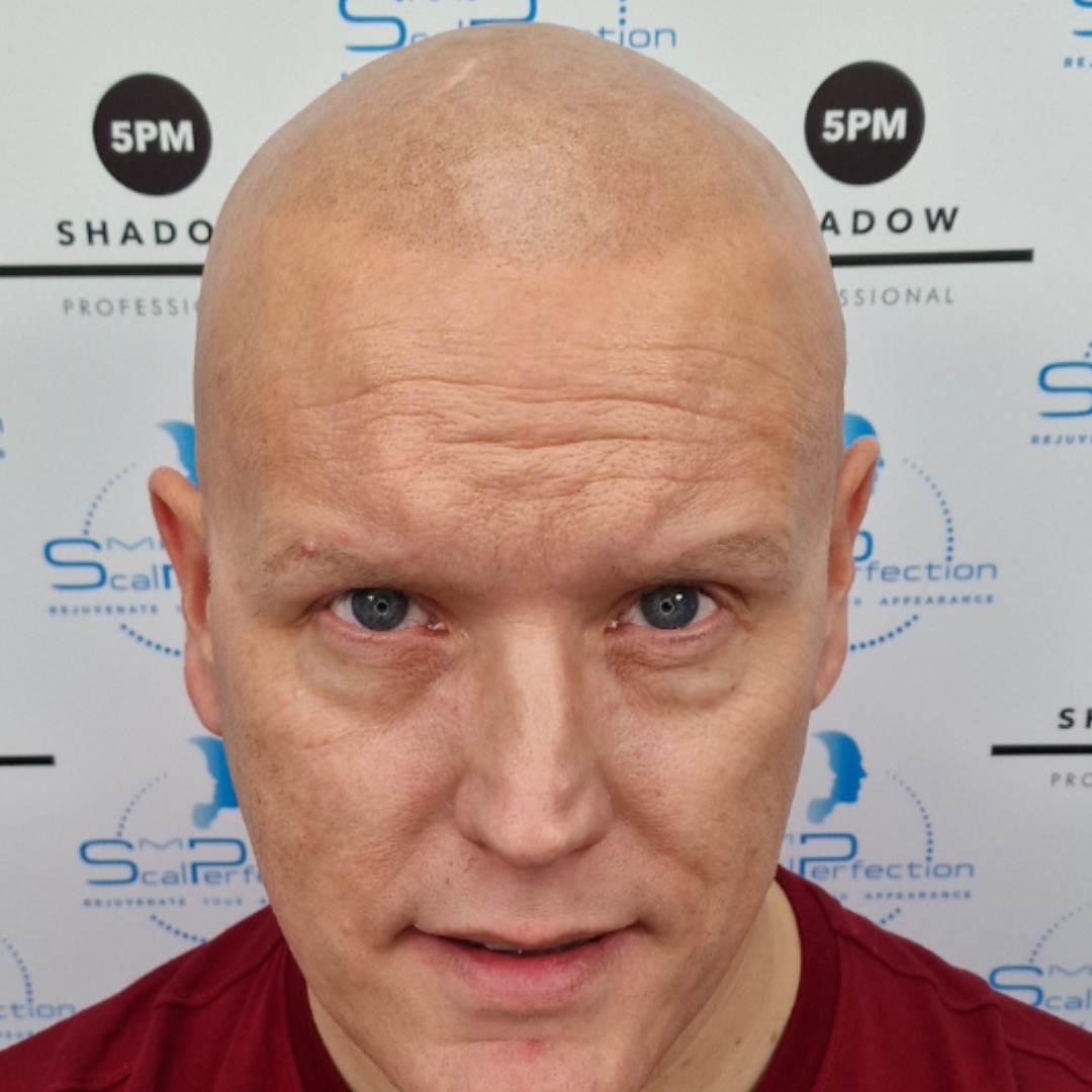 Alopecia Solution After Slider