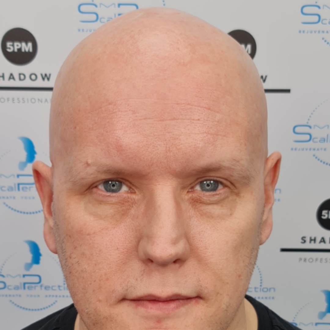 Alopecia Solution Before Slider Alopecia Solution Before Slider