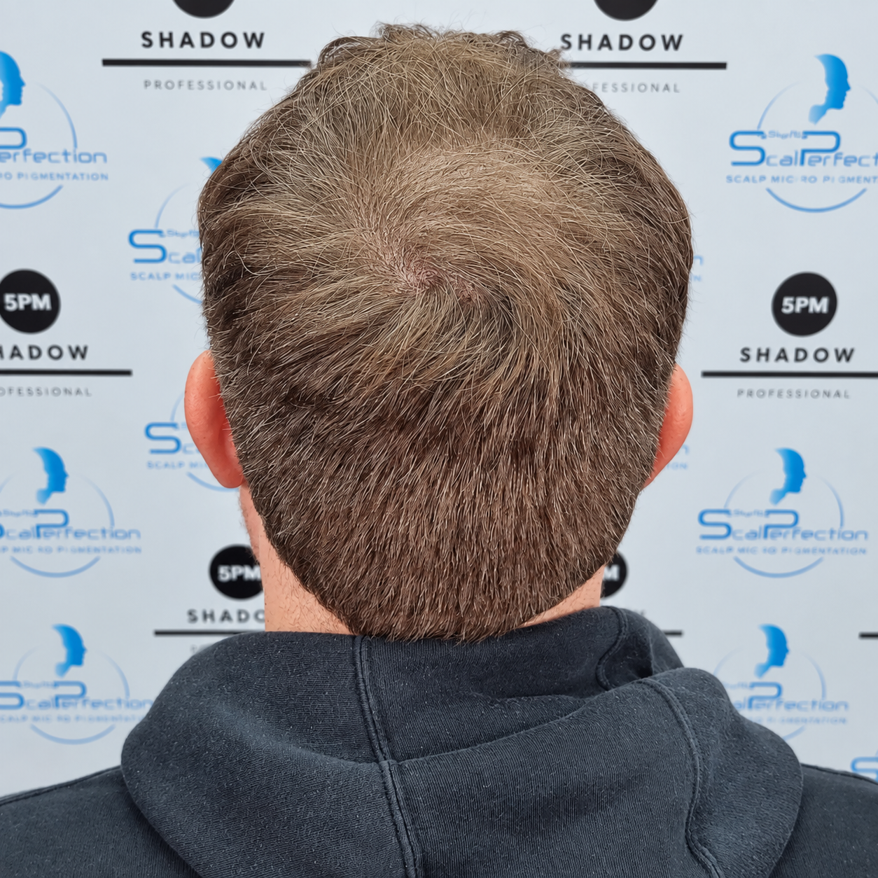 Folliculitis After Image