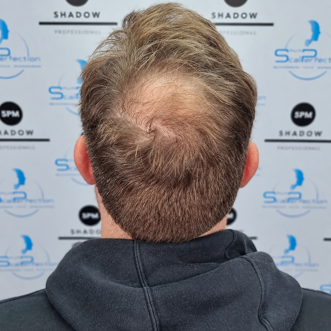 Folliculitis Before Image Folliculitis Before Image