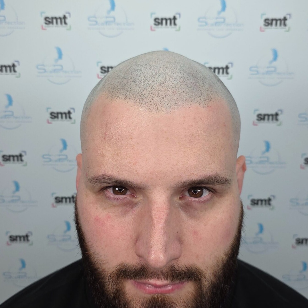 Medical Hair Loss After