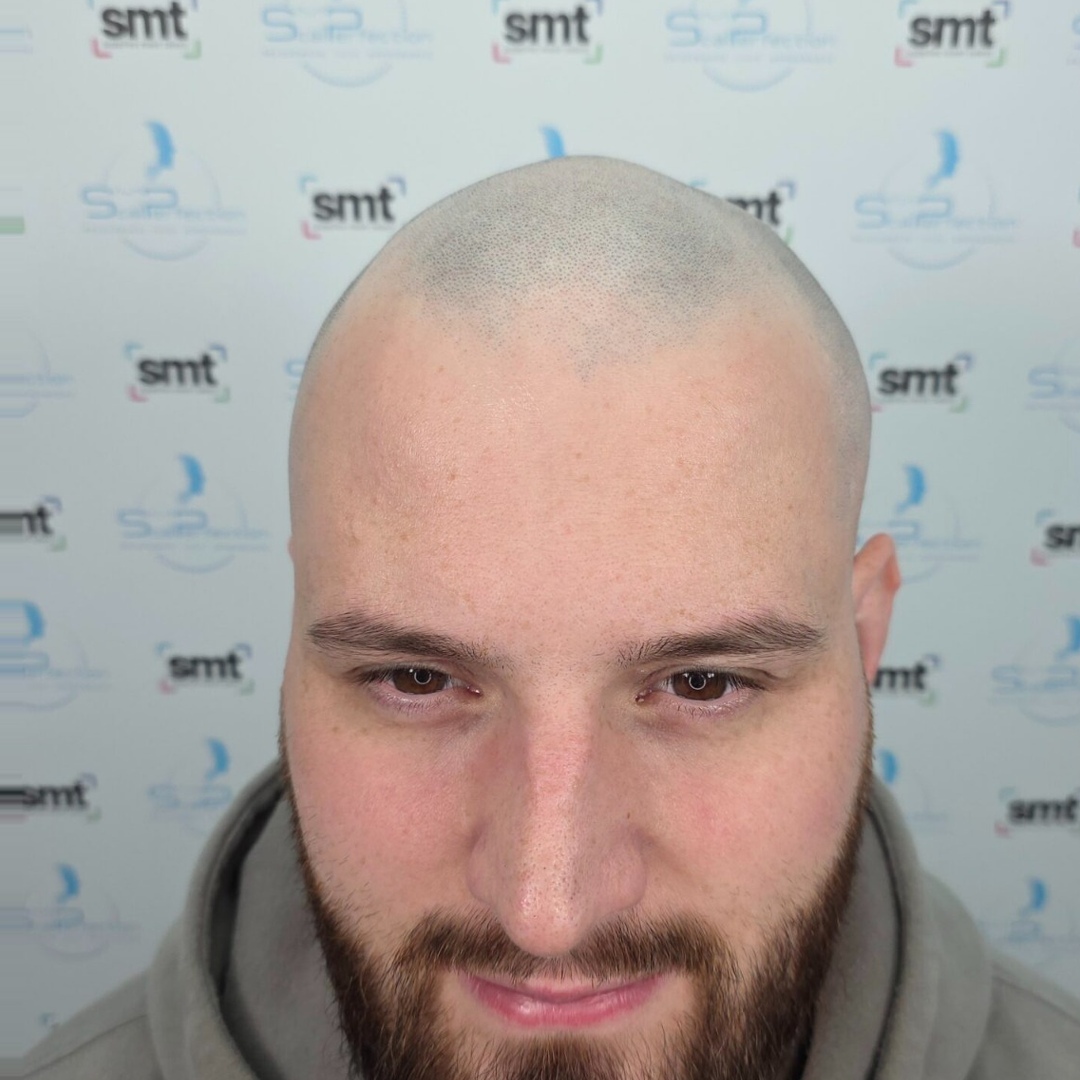 Medical Hair Loss Before Medical Hair Loss Before