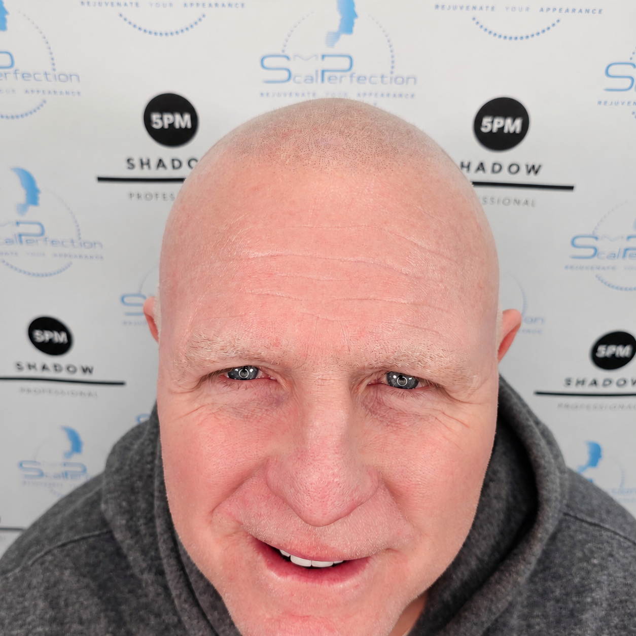 Thinning Hair After Image Final