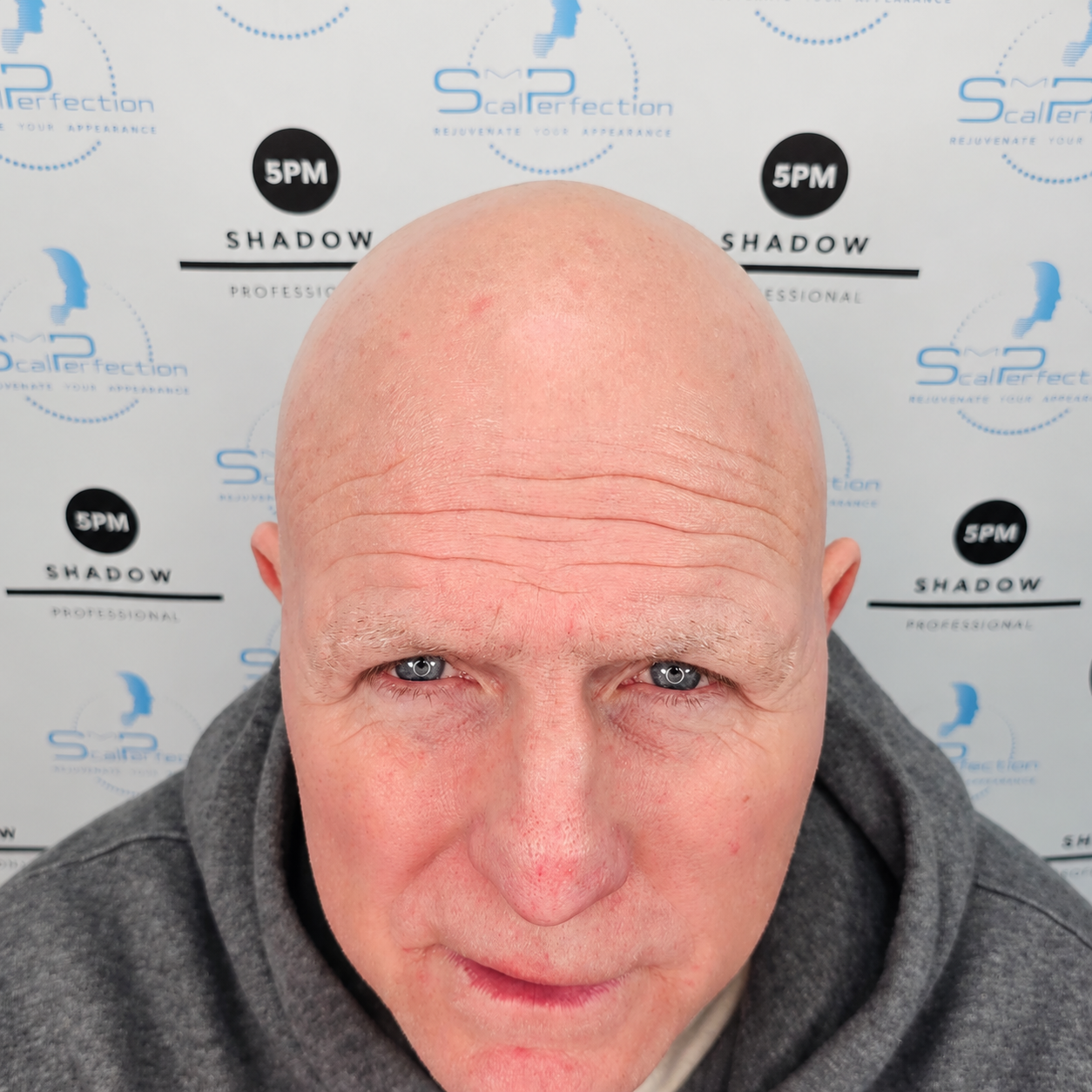 Thinning Hair Before Image Final